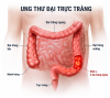 Kiến thức toàn diện về Ung thư Đại trực tràng
